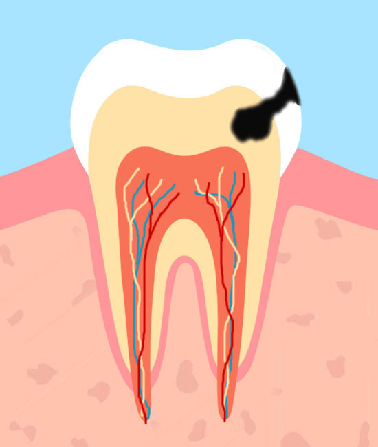 Терапевтическая стоматология, кариес зуба