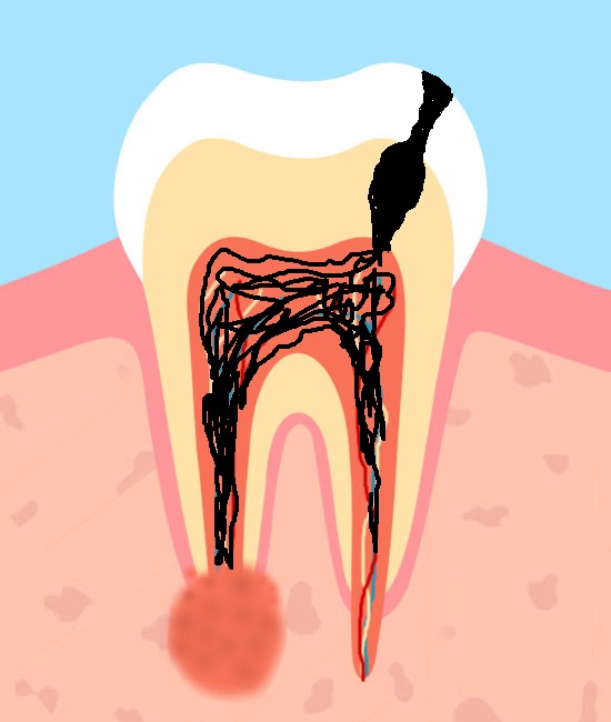 Терапевтическая стоматология, Периодонтит зуба
