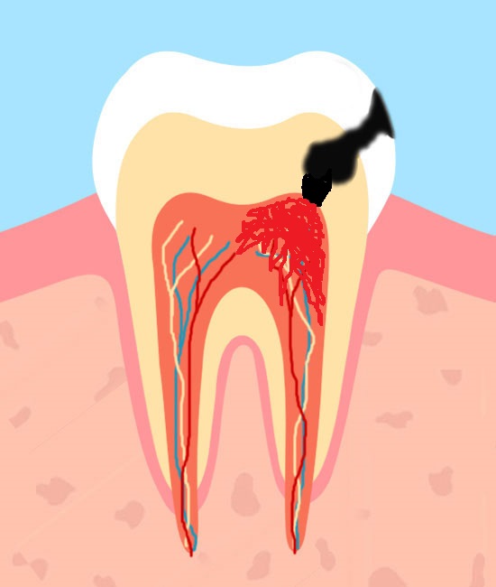 Терапевтическая стоматология, пульпит зуба